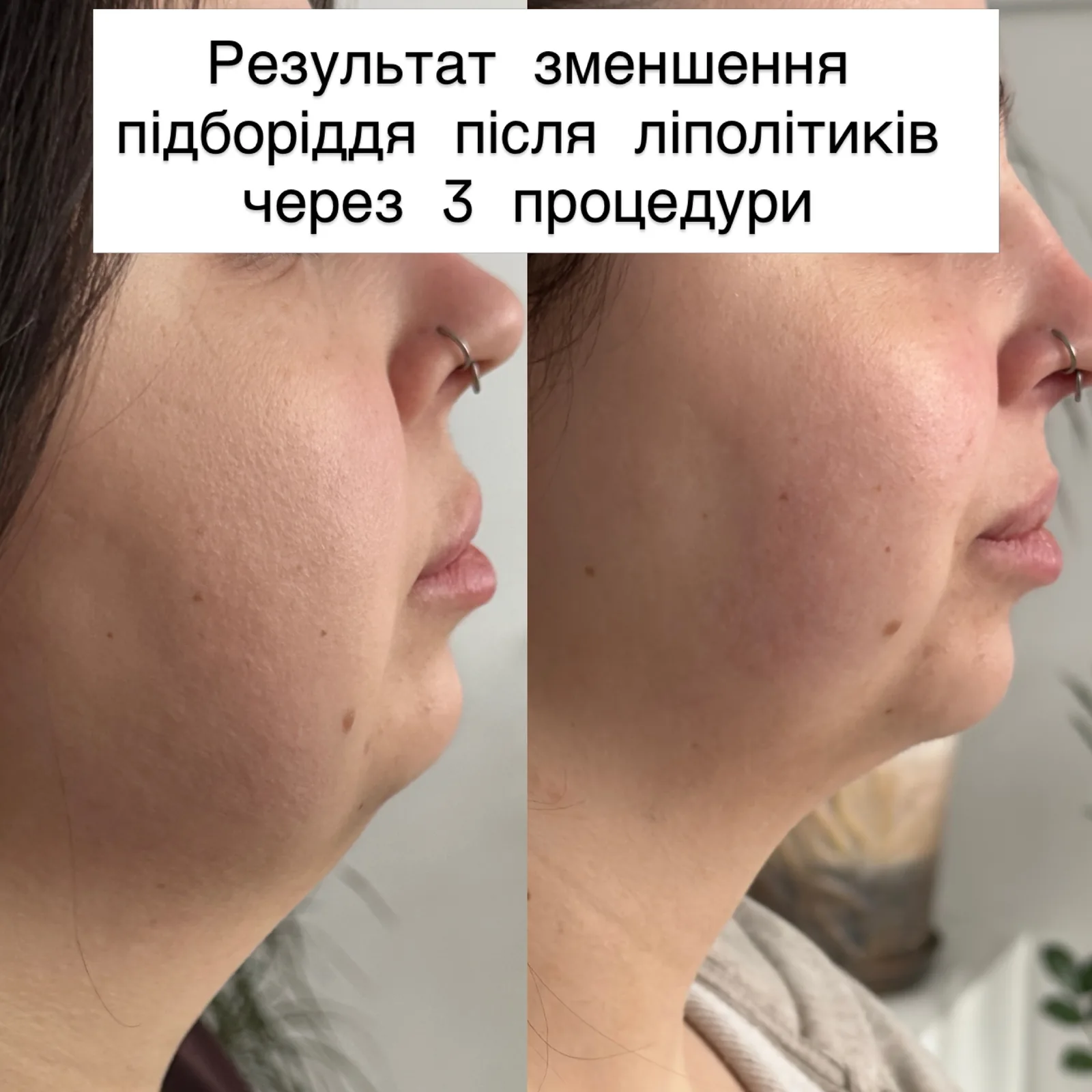 Ліполітики для підборіддя